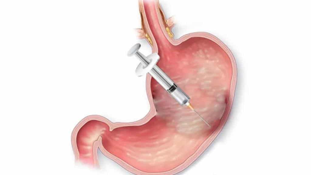 Geleneksel Mide Küçültme ile Botoks Mide Küçültme Arasındaki Fark Nedir?