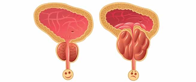 Prostat Büyümesi Tedavisi: İlaçlar mı Yoksa Ameliyat mı?