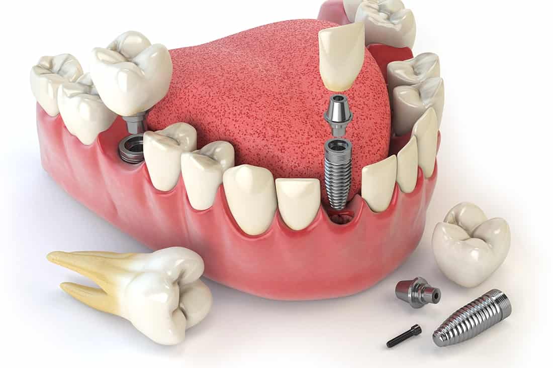 Türkiye'de Diş Nakli İçin En İyi Merkezi Nasıl Seçersiniz?  