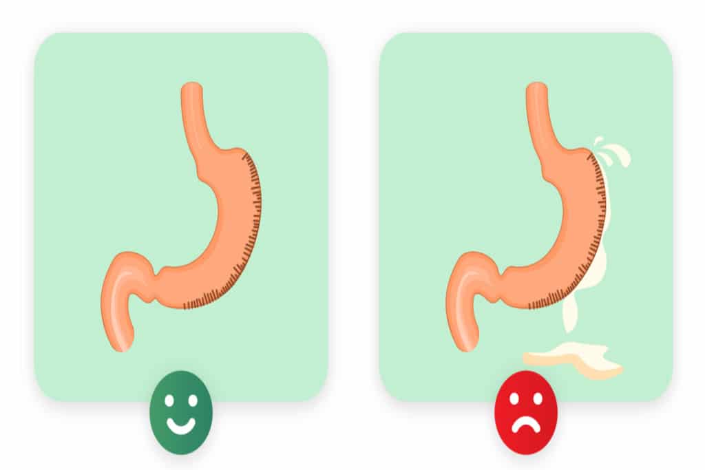 Mide Küçültme Ameliyatının Olası Komplikasyonları ve Önlenme Yolları