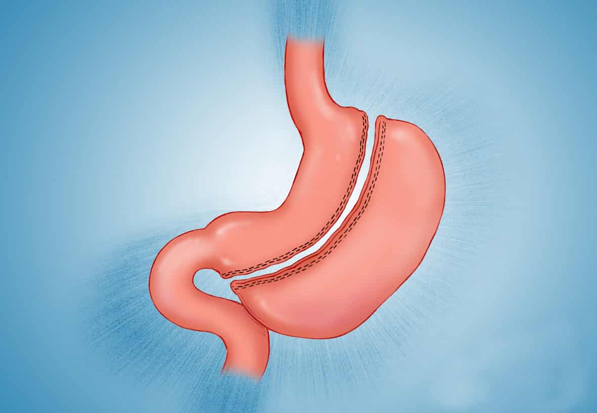 Mide Küçültmeye Aday mısınız? Hangi Durumlarda Yapılır?