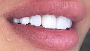 Diş Aşındırmadan Hollywood Gülümsemesi: Etkili mi?