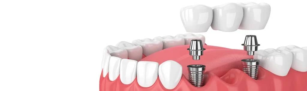 Türkiye'de Cerrahisiz Diş Ekimi Teknikleri