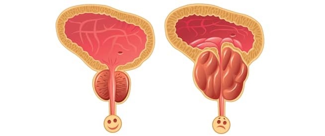 Prostat Büyümesi Tedavisi: İlaçlar mı Yoksa Ameliyat mı?