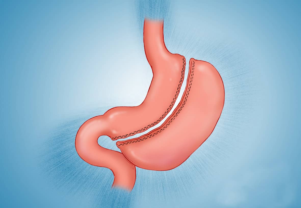 Mide Küçültmeye Aday mısınız? Hangi Durumlarda Yapılır?