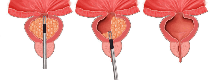 Ameliyatsız Prostat Büyümesi Tedavisinde En Yeni Teknolojiler