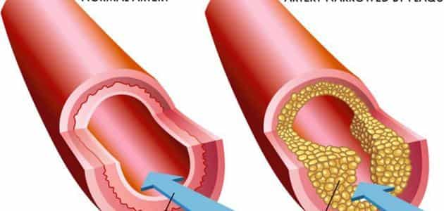Koroner Arter Tıkanıklığının Belirtileri ve Tedavi Seçenekleri