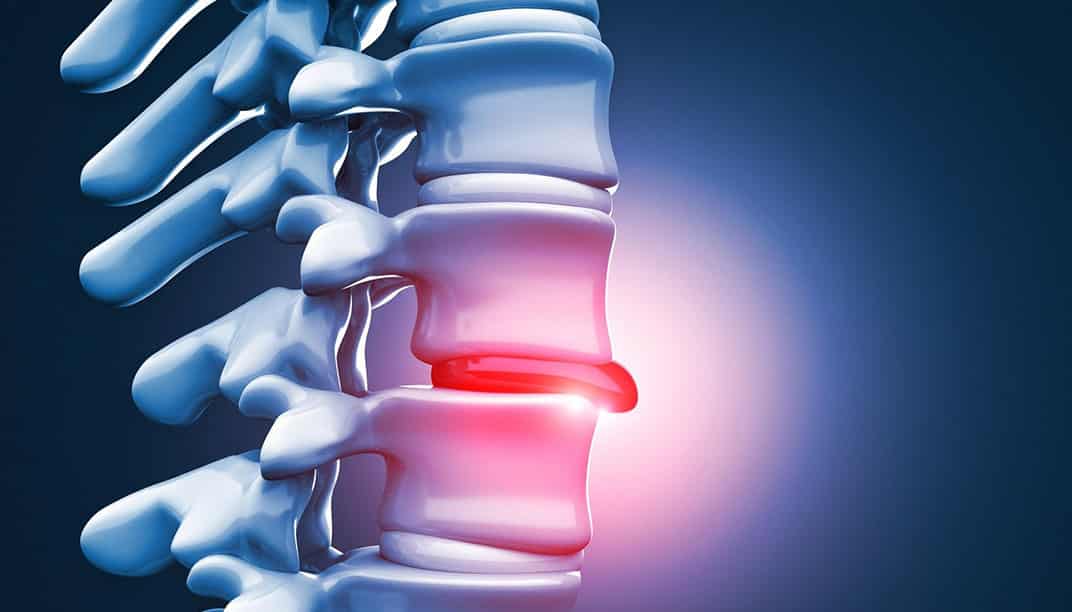 Herni: Ameliyat Ne Zaman Gerekir?