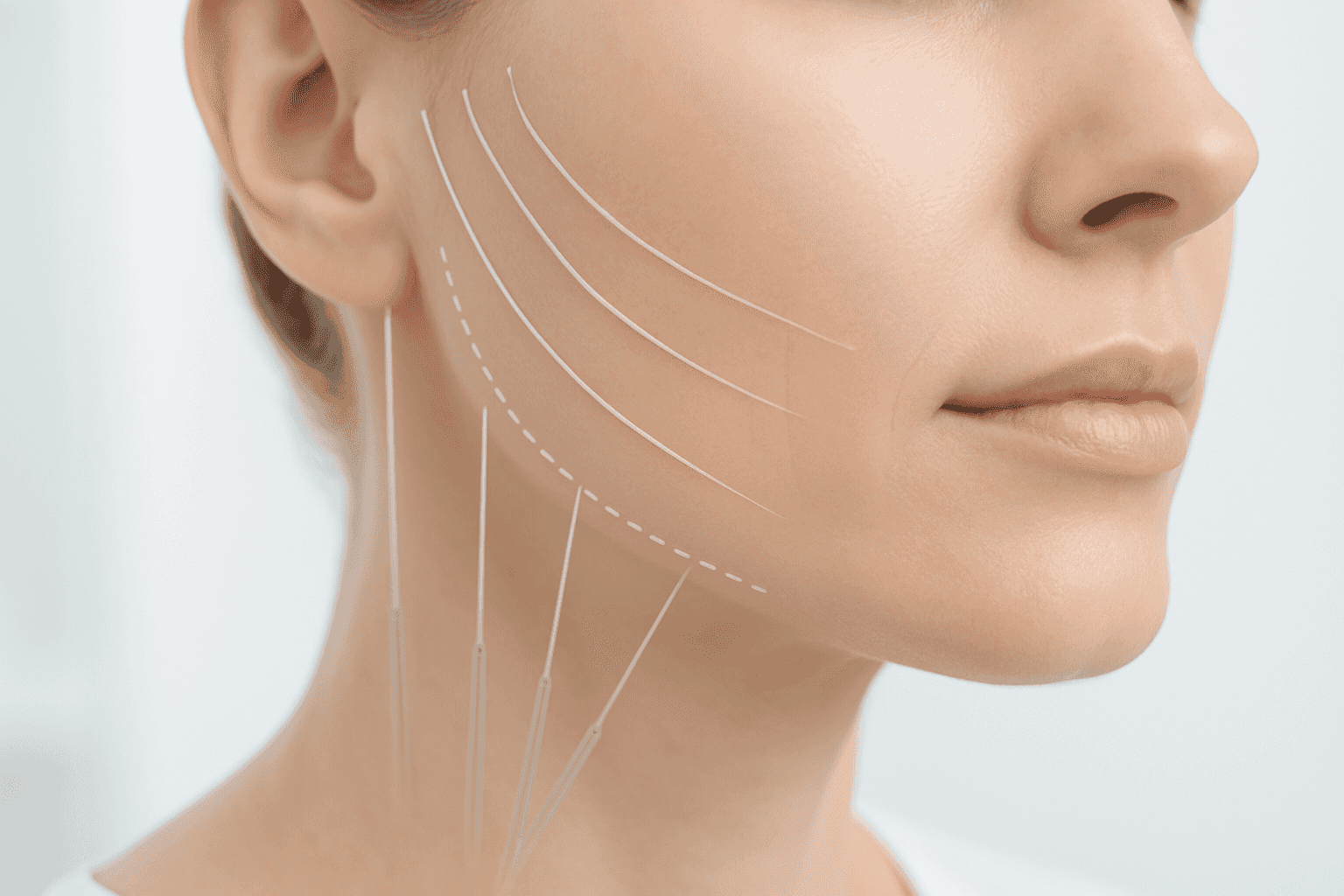 Thread Face Lift: Cerrahi Olmayan Bir Teknik ve Hızlı Sonuçlar