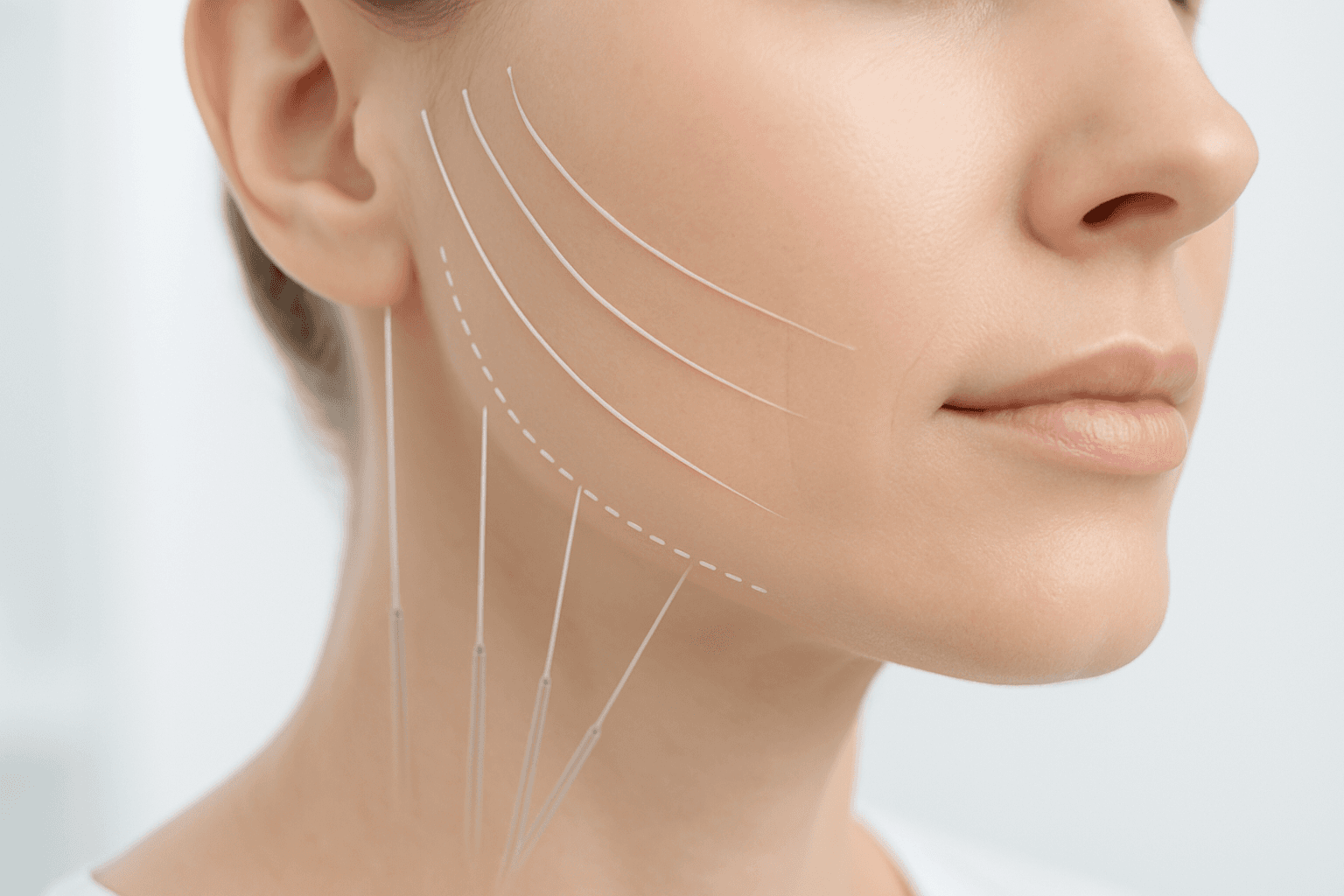 Thread Face Lift: Cerrahi Olmayan Bir Teknik ve Hızlı Sonuçlar