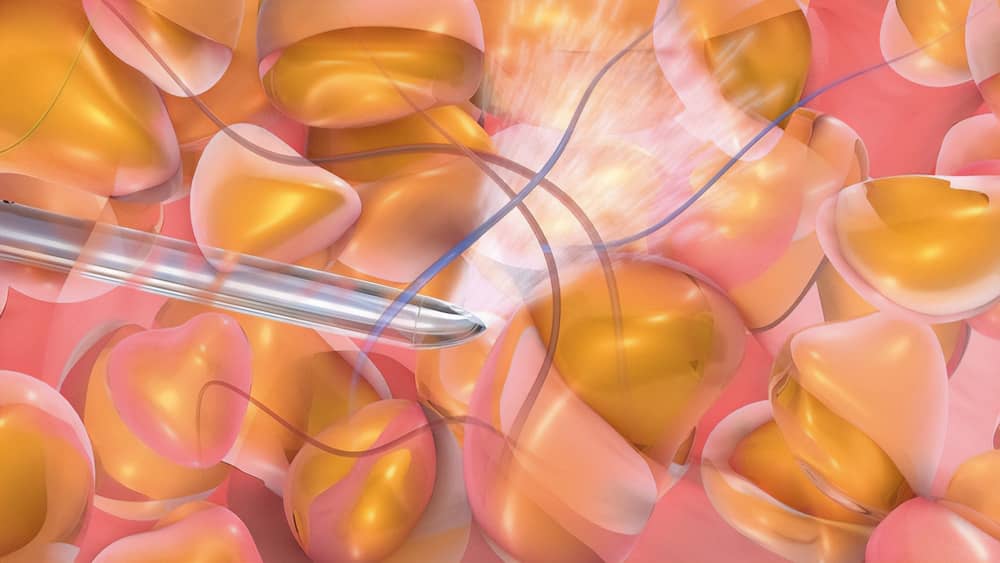 Vizor mu Yoksa Lazer mi? Liposuction'da Hangisi Daha İyi?