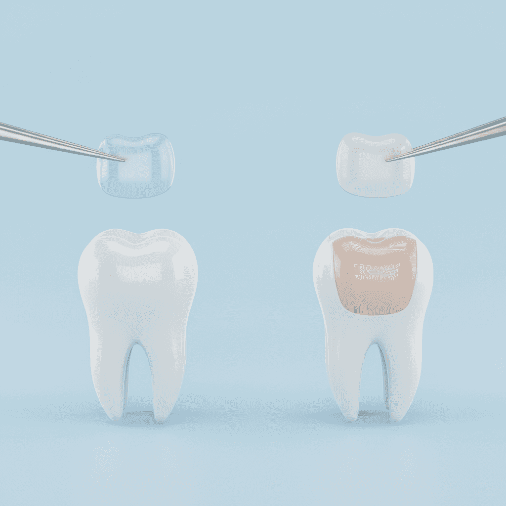 Lüminer mi Yoksa Veneer mi? Hangisi Sizin İçin Daha Uygun?