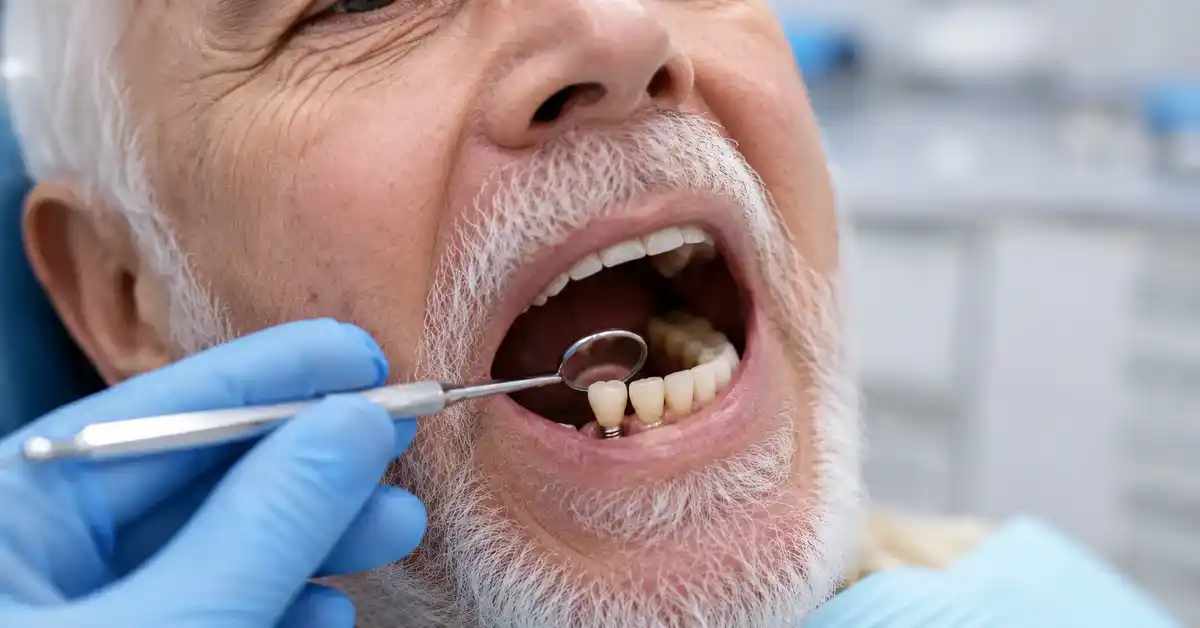 زراعة الأسنان لكبار السن: ما المتوقع