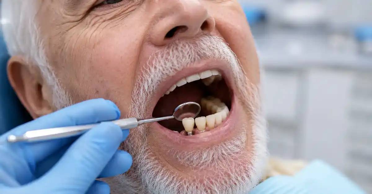 زراعة الأسنان لكبار السن: ما المتوقع