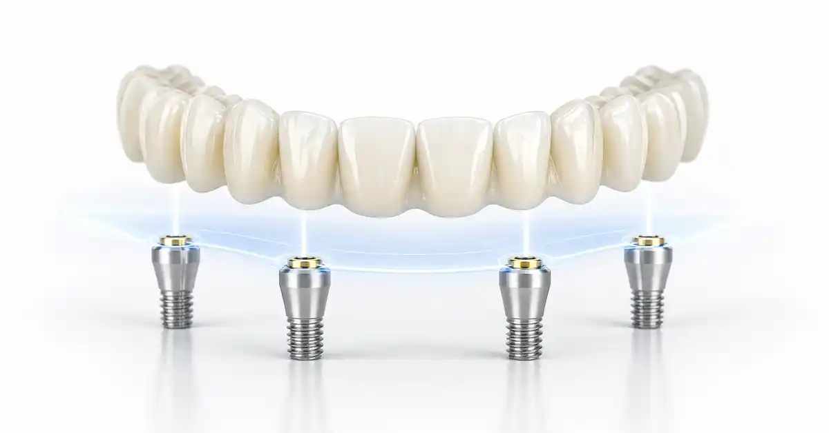 Innovation in Dental Implants: Understanding the All-on-4 Technique