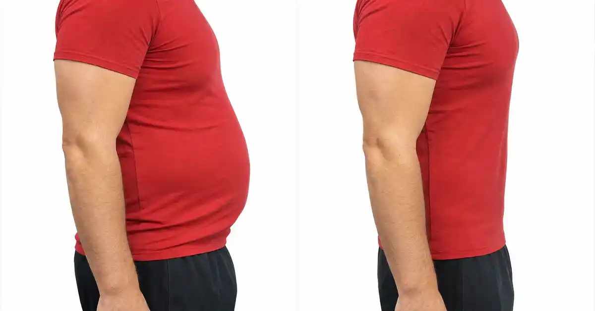 Male Liposuction: Benefits and Latest Fat Removal Techniques