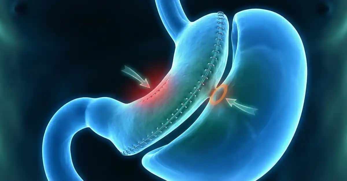 Mide Küçültme Ameliyatının Olası Komplikasyonları ve Önlenme Yolları