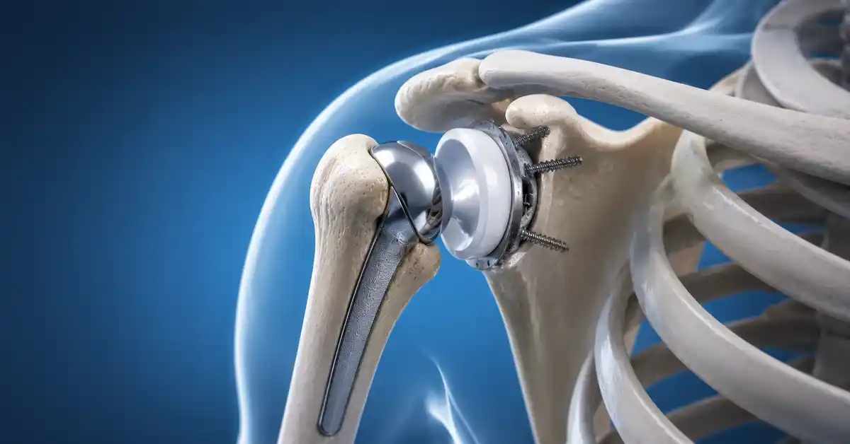 Shoulder Joint Replacement Surgery: When Is It Needed