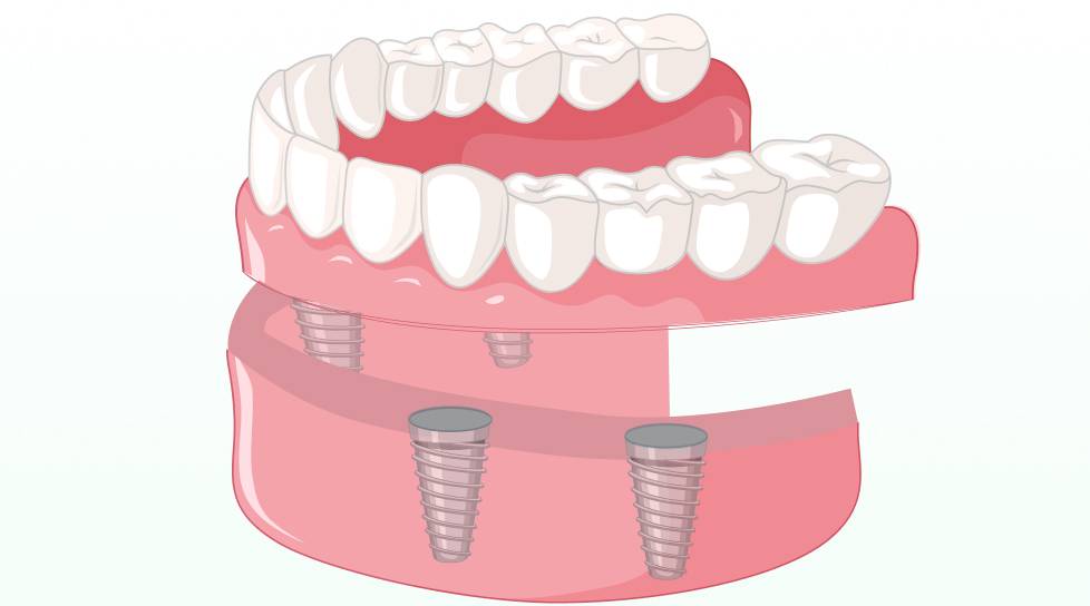 Full arch dental implants