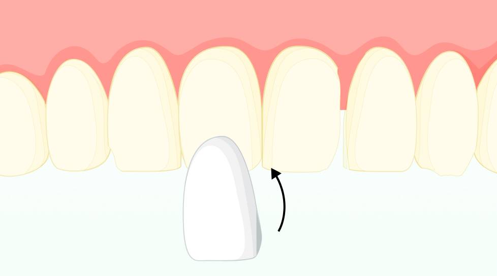 Dental veneers