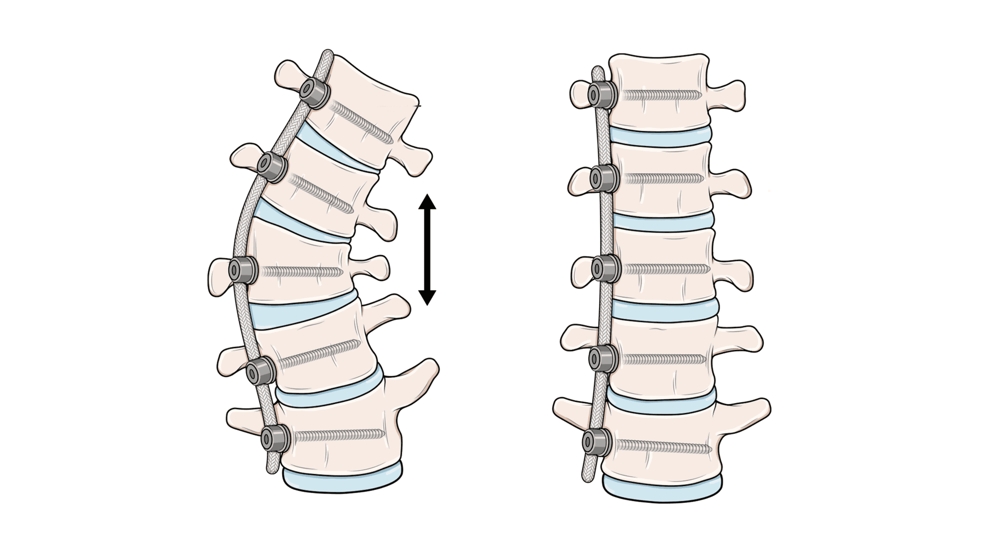 Scoliosis Surgery