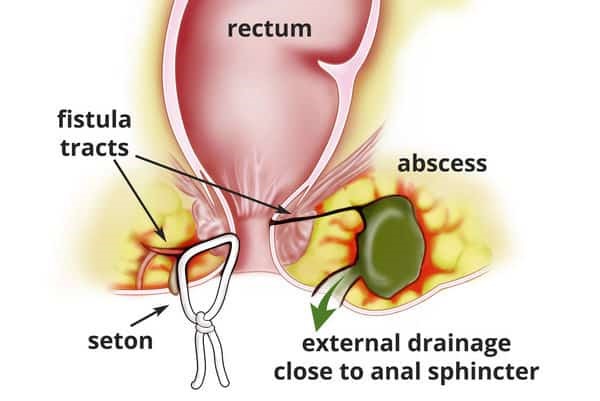 Seton Procedure For Anal Fistula Safe Management With Safemedigo seton-procedure-for-anal-fistula-safe-management-with-safemedigo